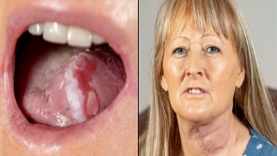 أطباء يقطعون لسان مريضة ولوزتيها ومعظم أسنانها