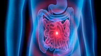 دراسة تكشف عن الحل الجذري لسرطان الأمعاء