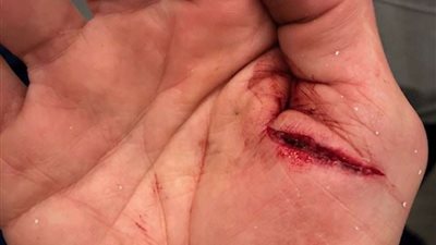 أهمهم وصفة الخيار.. 3 طرق منزلية لإزالة آثار الجروح