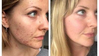 بالفيديو.. تخلصي من الحبوب بسهولة عن طريق المكياج