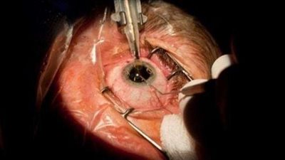 نقل قرنية العين يثير الجدل بين النواب.. والدستور يبيحها بشروط