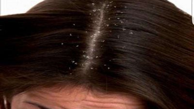 أسهل طريقة للتخلص من ”قشرة الرأس“ في المنزل