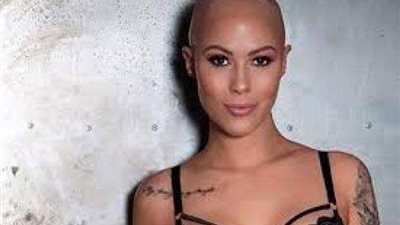 حملة عالمية لدخول نساء الثعلبة لعالم الموضة