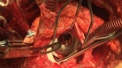 طاقم جراحة القلب بمستشفى جامعة بني سويف ينقذون حياة مريضة توقفت عضلة قلبها