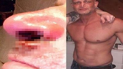 الكوكايين يتسبب فى تآكل أنف بريطاني بعد 25 عام من التعاطي