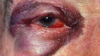 لأول مرة.. مستشفى بركة السبع بالمنوفية تجري جراحة لزراعة قرنية