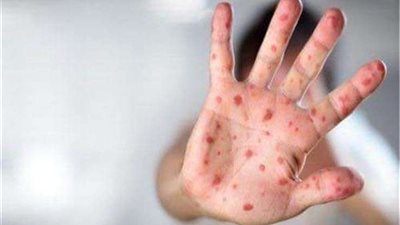 أمريكا تسجل ثاني أعلى حالات الإصابة بالحصبة منذ 19 عامًا