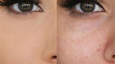 تخلصي من المسام الواسعة بخطوة واحدة