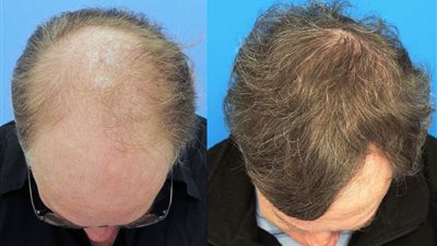 تعرف على أبرز طرق زراعة الشعر وأنواعها المختلفة