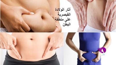 طبيب يوضح كيف تستعيد المرأة رشاقتها بعد الولادة القيصرية