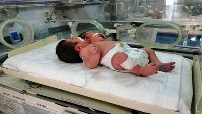 القومي لحقوق الإنسان يناشد رئيس الجمهورية بالتدخل لفصل طفل برأسين