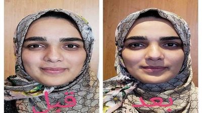 تعرفي على فوائد التجميل بالطاقة الحيوية ونتائجه المذهلة