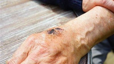 طبيب تجميل يوضح كيفية زراعة جلد جديد من نفس الشخص