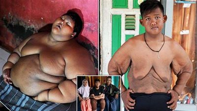 شاهد.. أسمن طفل بالعالم يفقد أكثر من نصف وزنه