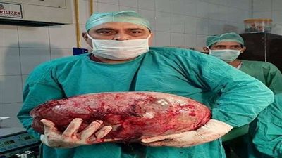 بالصور.. جراحة نادرة لاستئصال ورم يزن 15 كجم من فتاة بالهند