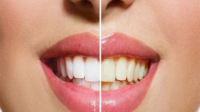 تعرفي على الحل النهائى لعلاج  الأسنان الصفراء و المشوهة والمصبوغة