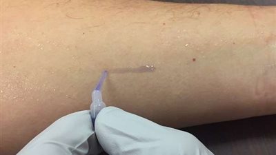 ابتكار صمغ طبي لالتئام الجروح بدون خياطة