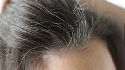 في 3 نقاط.. عوامل ظهور الشعر الأبيض مبكرًا