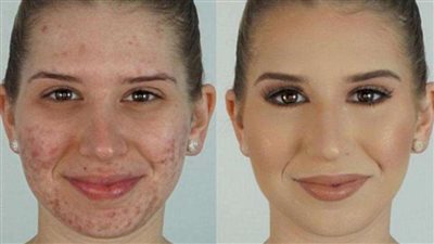 حيلة سحرية للتخلص من حب الشباب قبل العيد