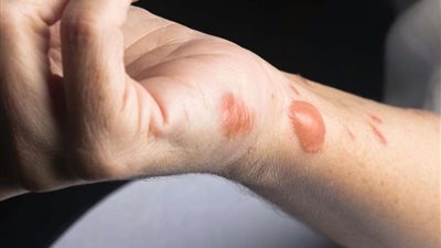 حل سحري لعلاج الجروح والحروق فى 9 أيام