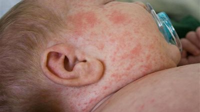 في 4 خطوات..إحمي نفسك من حمو النيل فى الصيف