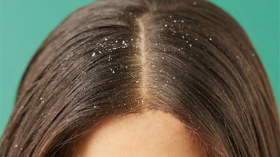 تعرفي على أسباب ظهور قشرة الشعر فى فصل الصيف