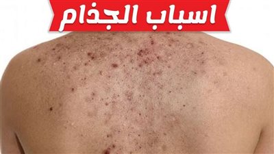 في يومه العالمي.. أعراض مبكرة تكشف إصابتك بالجذام