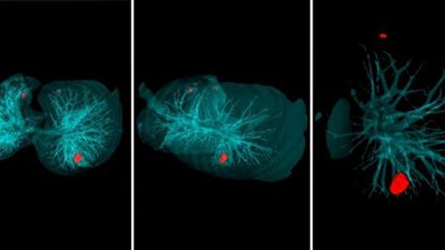 ابتكار روسى جديد يكشف السرطان فى 20 ثانية