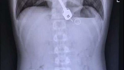 أين المفاتيح؟.. رجل صيني مخمور يبتلع مفاتيح منزله