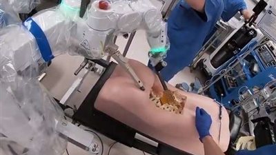 بالفيديو.. أول روبوت لتحسين كفاءة جراحات العمود الفقري