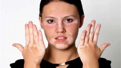 حقيقة تأثر مريض البهاق بدرجة الحرارة العالية فى الصيف؟