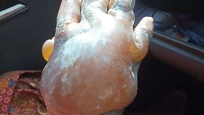 شاهد.. كارثة صحية يسببها معجون الأسنان على حروق الجلد