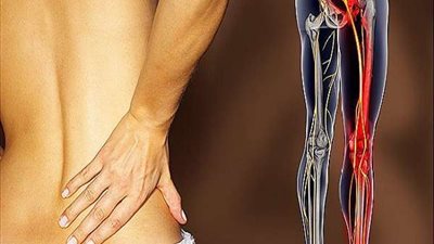 استشاري جراحة عظام يوضح طرق علاج عرق النسا