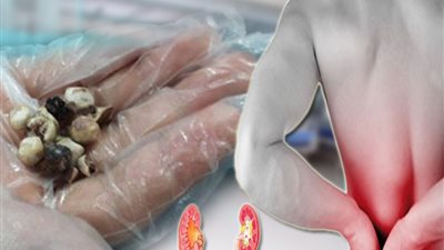 فى 5 خطوات كيف تحمي نفسك من حصوات الكلى في فصل الصيف