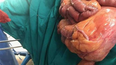 بالصور .. استئصال فتق 