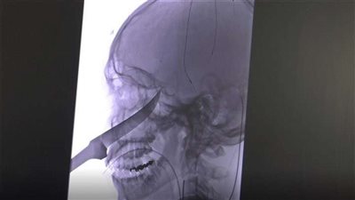 بالصور.. إنقاذ شاب بعد اختراق سكين بطول 23 سنتيمتر لجمجمته