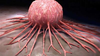 دراسة تكشف عن حل سحري للحماية من سرطان الأمعاء