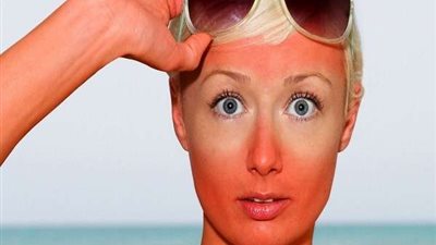 الطبيعي يكسب| وصفة سحرية لعلاج حروق الشمس