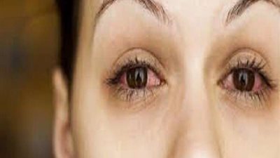 5 نصائح تخلصك من احمرار العين بعد السباحة