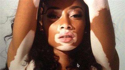 في يومه العالمي.. حكايات وخبايا مرضى ”البهاق” في مصر