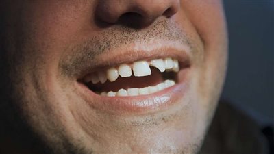 استشاري: تقنية دائمة لعلاج الأسنان المكسورة