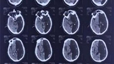 واشترك في الحرب العالمية الثانية.. رجل عاش حياته بنصف مخ