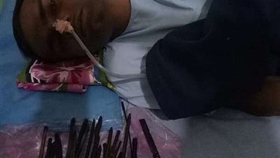 أطباء يستخرجون سكاكين وشفرات حلاقة من أمعاء مريض