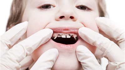 أبرزها مضغ الثلج.. أطعمة ومشروبات تسبب تسوس الأسنان