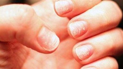 أعراض وحلول نقص الزنك والحديد في الجسم