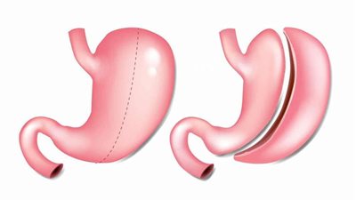 استشاري جراحات سمنة: عمليات تكميم المعدة في تطور دائم