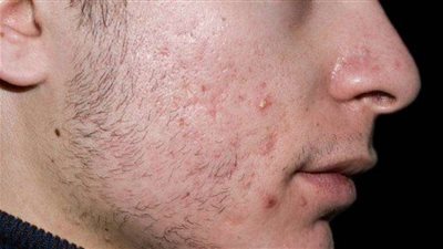 طبيب تجميل يوضح أنواع التقشير الكيميائي لإزالة ندوب الوجه