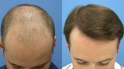 هل سيكون هناك حل دائم لمشاكل تساقط الشعر؟