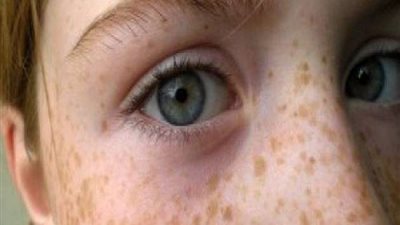 استشاري تجميل يوضح كيفية علاج النمش وبقع الجلد