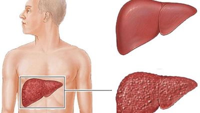 أستاذ بطب عين شمس يوضح طرق علاج أورام الكبد